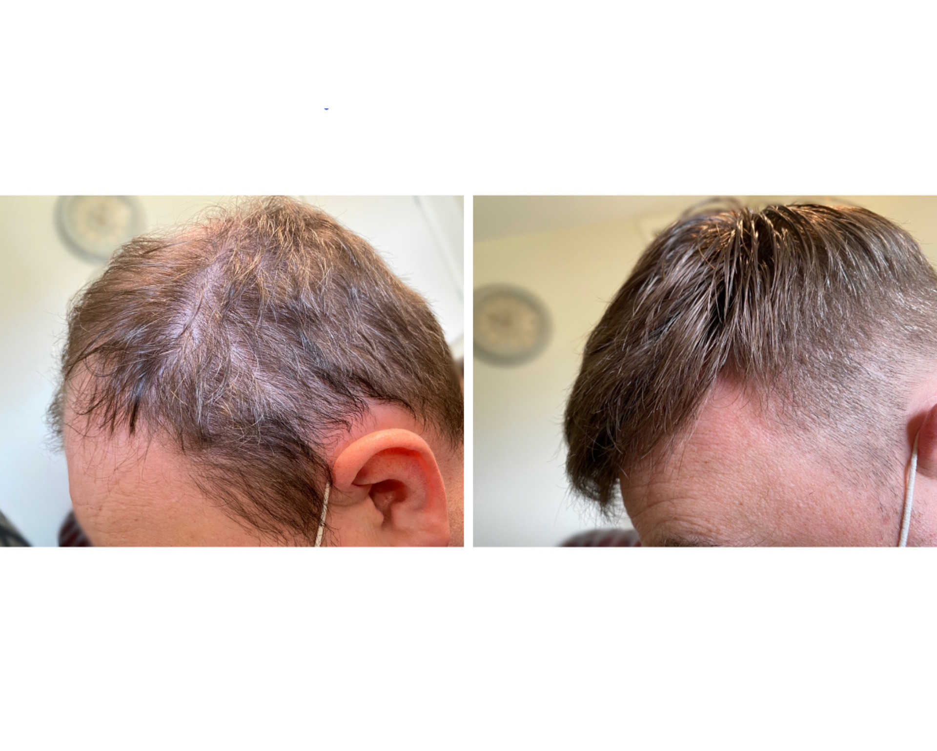 Mens hair system fitted by KA Hair Solutions Ireland